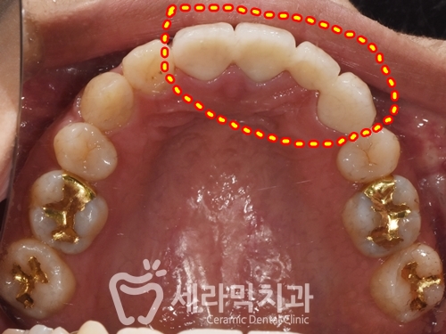 돌출입 치아벌어짐 치아재교정 전후. 세라믹치과 관련 이미지 10
