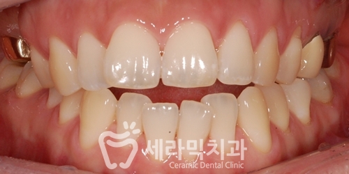상실된 치아가 있어도, 금니가 있어도 치아교정전후는 계속된다! 관련 이미지 2