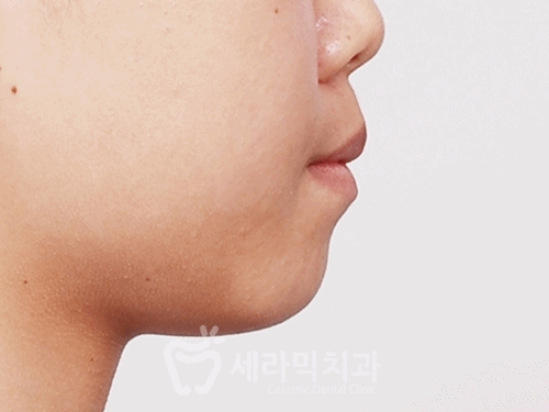 학동역 치아교정, 수술없이 예뻐져도 되나요? [돌출입교정 전후 달라진 외모] 관련 이미지 3