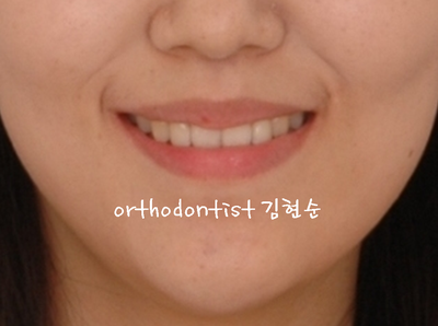 개방 교합 관련 이미지 31