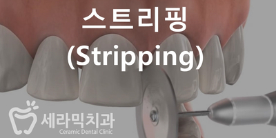 치아교정 부작용 3. 치아 사이 틈(블랙트라이앵글) 관련 이미지 8