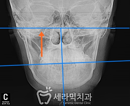 얼굴 비대칭 치아교정전후, 수술 없이 얼마나 개선될까요? 관련 이미지 2