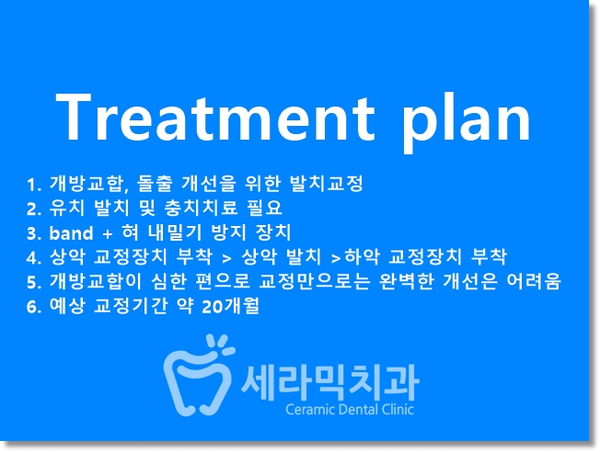 돌출입과 개방교합 치아교정 치료전후 관련 이미지 11
