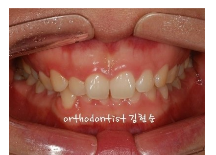 강남 과개 교합 관련 이미지 3