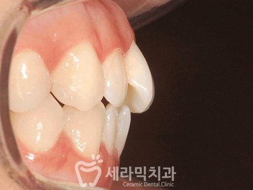 벌어진 나비치아 돌출입 치아교정전후 관련 이미지 4