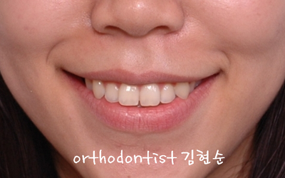 강남 돌출 관련 이미지 3