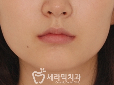 토끼이빨 돌출입 치아교정 전후 표정변화! 관련 이미지 13