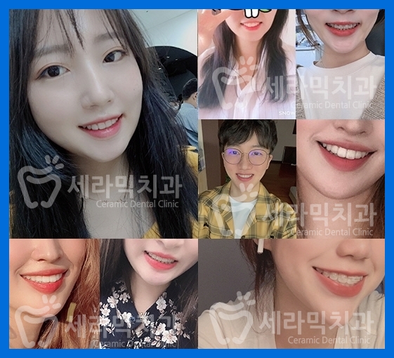 돌출입 투명교정으로 세련된 옆라인을 완성한 치아교정전후 관련 이미지 5