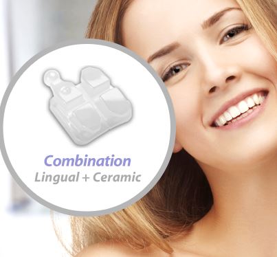 세라믹교정 세라믹치과 - 콤비네이션 교정이란 ? 관련 이미지 6