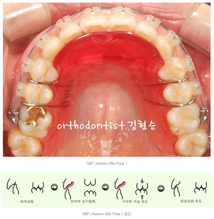 강남 과개 교합 관련 이미지 6
