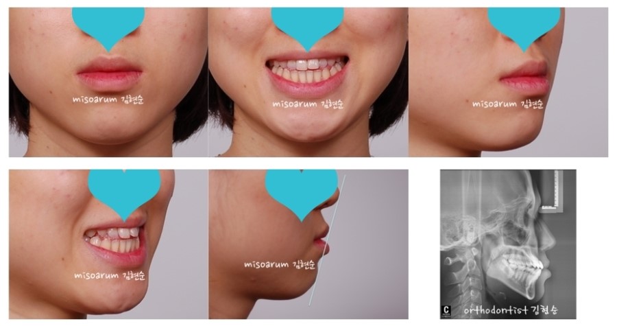 주걱턱교정 수술없이 해결? 관련 이미지 8