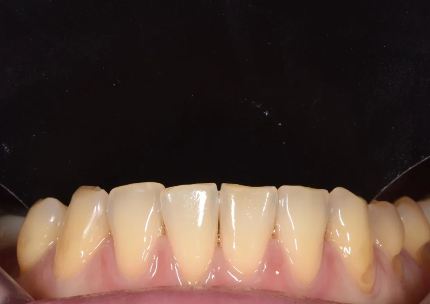 학동역 라미네이트 전후, 치아 모양과 색상 개선 사례 관련 이미지 9