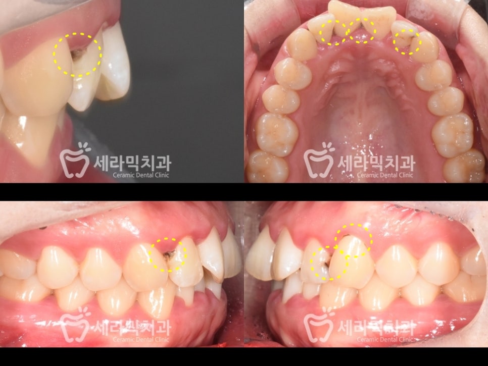 과개교합과 삐뚤빼뚤한 치열, 돌출입 앞니 치아교정전후 관련 이미지 3