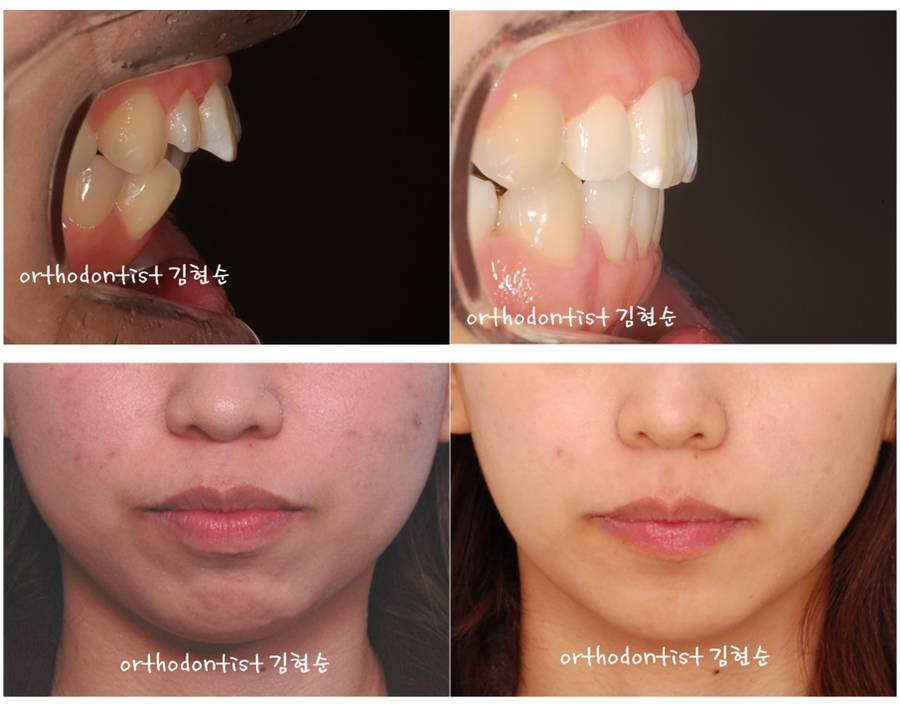 세라믹교정 세라믹치과-돌출입발치교정 5 관련 이미지 6