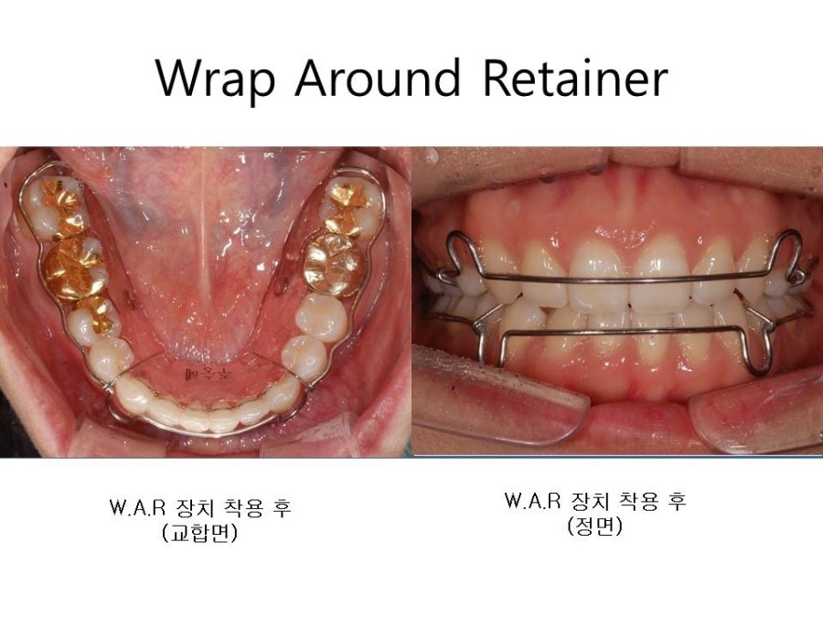 학동역치과 치아교정 잘하는 곳 ! 관련 이미지 25