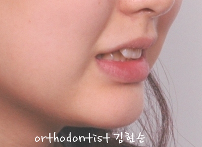 강남 돌출 (토끼 치아) 관련 이미지 4