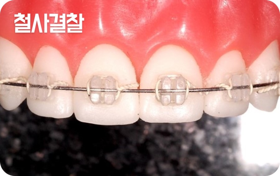 교정장치 구분하기 관련 이미지 3