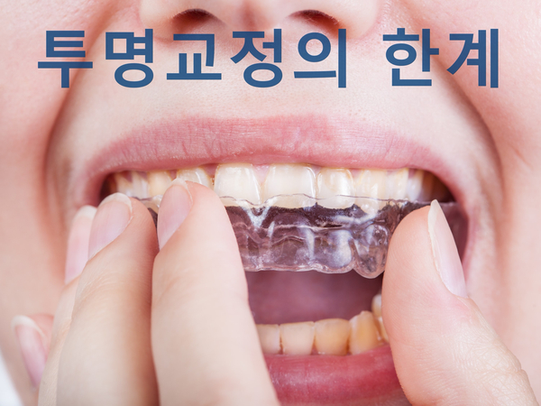 강남 치아교정잘하는곳 찾는 성공 팁! 관련 이미지 9