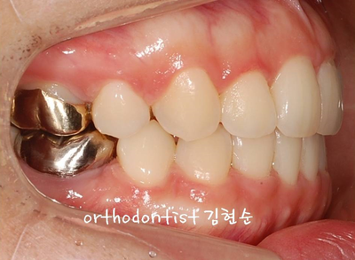 강남 돌출입 교정 관련 이미지 21