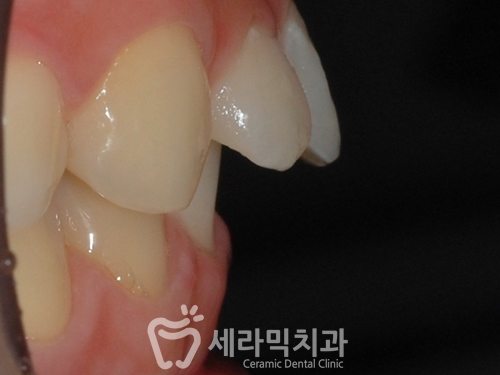 벌어진 돌출입 치아교정으로 빈틈없이 깔끔하게! 관련 이미지 2