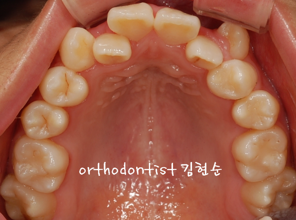 강남 덧니 관련 이미지 3