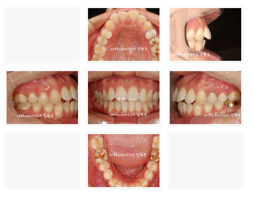 돌출입발치 교정증례 관련 이미지 2