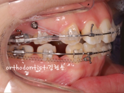 강남치아교정추천 관련 이미지 21