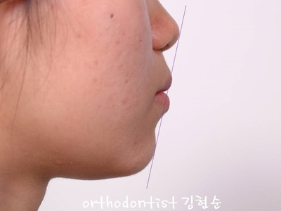 강남 돌출입 교정 관련 이미지 4