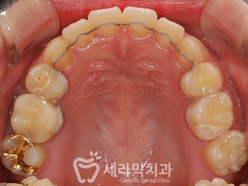 돌출입교정으로 갸름한 턱라인까지 되찾다! 돌출입 치아교정전후 관련 이미지 25