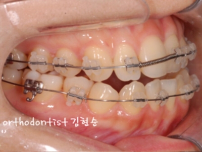 강남교정치과 관련 이미지 24