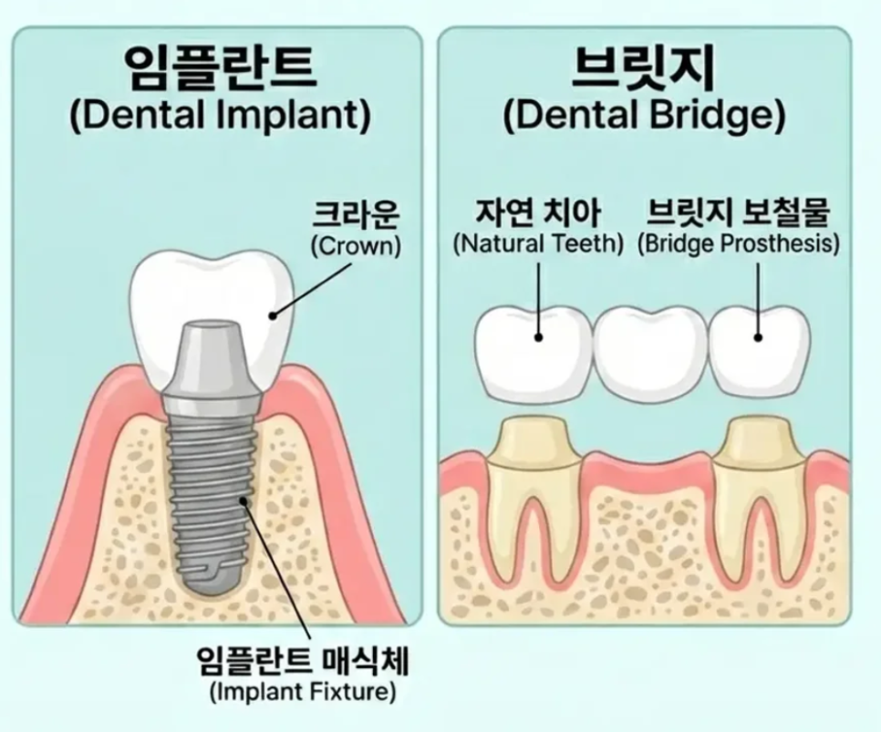 역삼동 치과, 임플란트 안 심고 살면 안 되나요? 관련 이미지 6