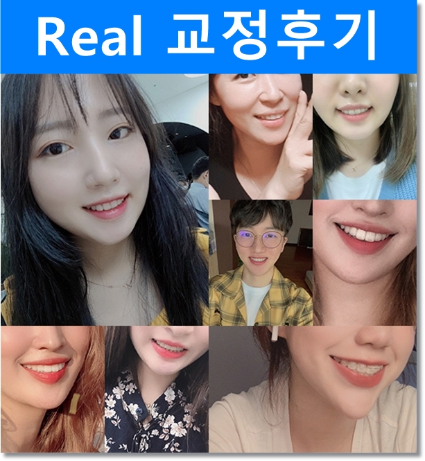 돌출입 앞니부분교정 치아교정전후 더 환해진 미소! 관련 이미지 4