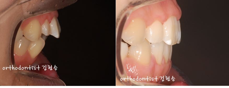 세라믹치과 "돌출입 발치교정" 관련 이미지 8