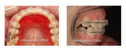 과개교합 ABP 교정 관련 이미지 8
