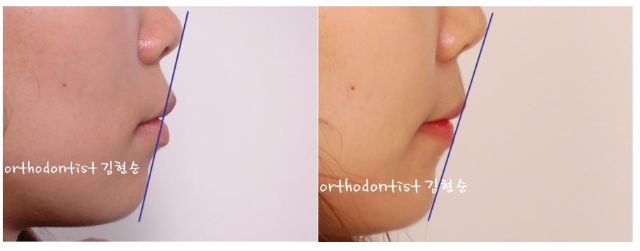 세라믹교정 은 세라믹치과 돌출입발치 관련 이미지 8