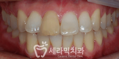 돌출입 치아교정전후, 갸름하고 부드러운 옆라인 완성! 관련 이미지 6