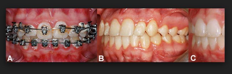 치아교정 부작용 탈회와 치아우식 관련 이미지 5