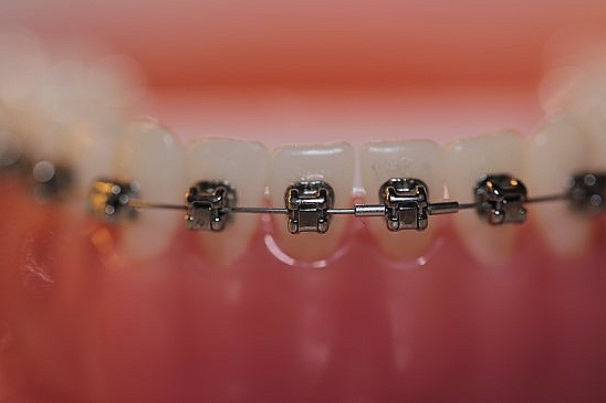 강남 세라믹 교정 관련 이미지 5