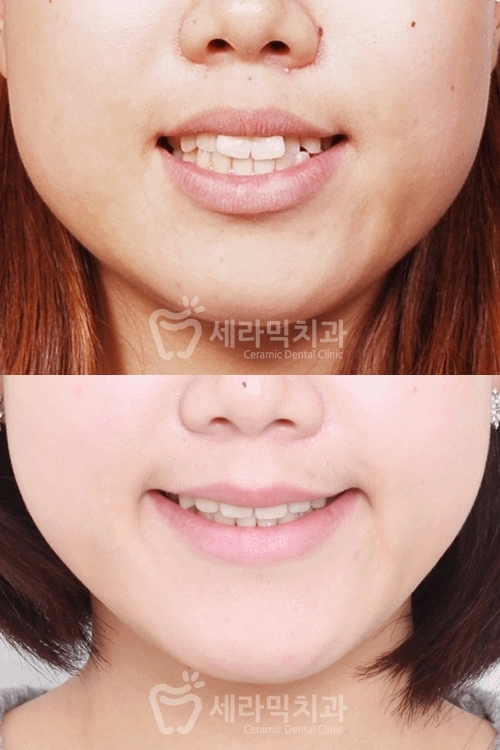 학동역 치아교정, 수술없이 예뻐져도 되나요? [돌출입교정 전후 달라진 외모] 관련 이미지 1