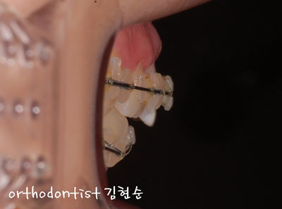 강남 돌출 관련 이미지 19