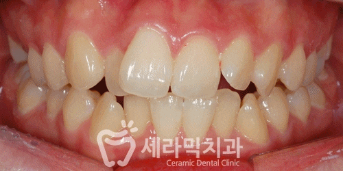 삐뚤빼뚤 치열불규칙 치아교정전후 달라진 미소 관련 이미지 4
