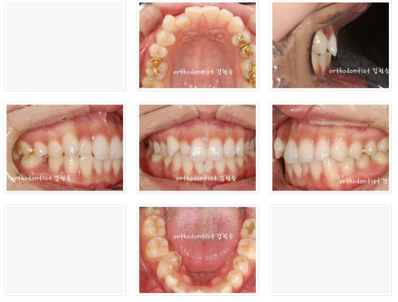 세라믹교정 은 "세라믹 치과 " 관련 이미지 3