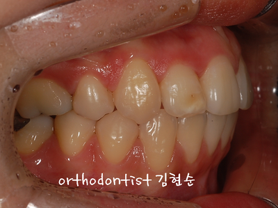 강남 돌출 관련 이미지 21