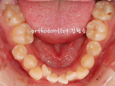치열 교정(치열 불규칙) 관련 이미지 8