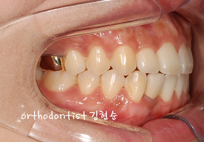 치열 교정 ( 벌어짐 ) 관련 이미지 21