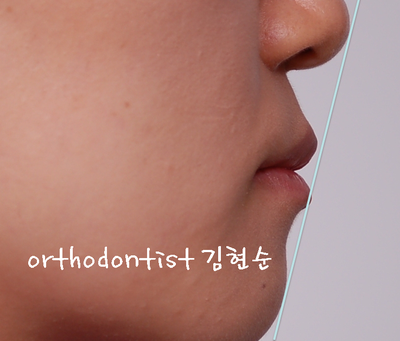 강남 덧니 관련 이미지 28