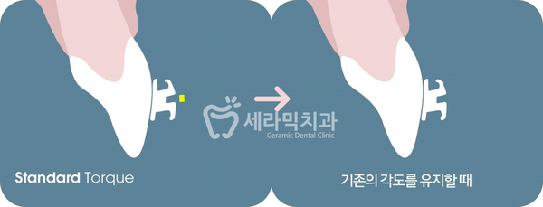 옥니 없이 치아교정잘하는곳, 강남 세라믹치과 관련 이미지 6