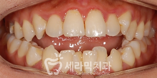 개방교합 때문에 시작한 치아교정. 돌출과 무턱까지 한번에 해결! 관련 이미지 2