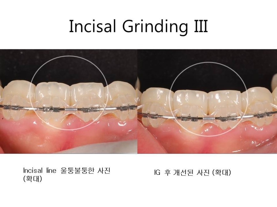 학동역치과 치아교정 잘하는 곳 ! 관련 이미지 31