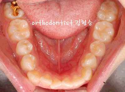 강남 돌출 관련 이미지 10